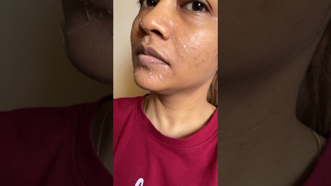 Chemical peel treatment experience 😳 #shortsvideo #shorts #trending #viralvideo #beauty