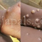 Abia State Confirms First Case Of Monkey Pox